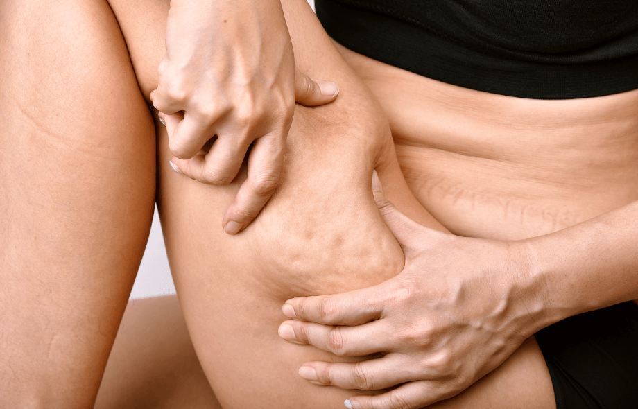 Eliminare la cellulite in 7 giorni è possibile?